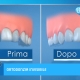 allineamento dentale, illustrazione prima e dopo la cura
