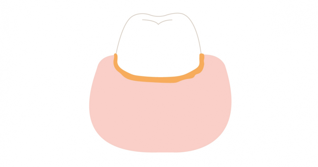 dente-con-placca-illustrazione
