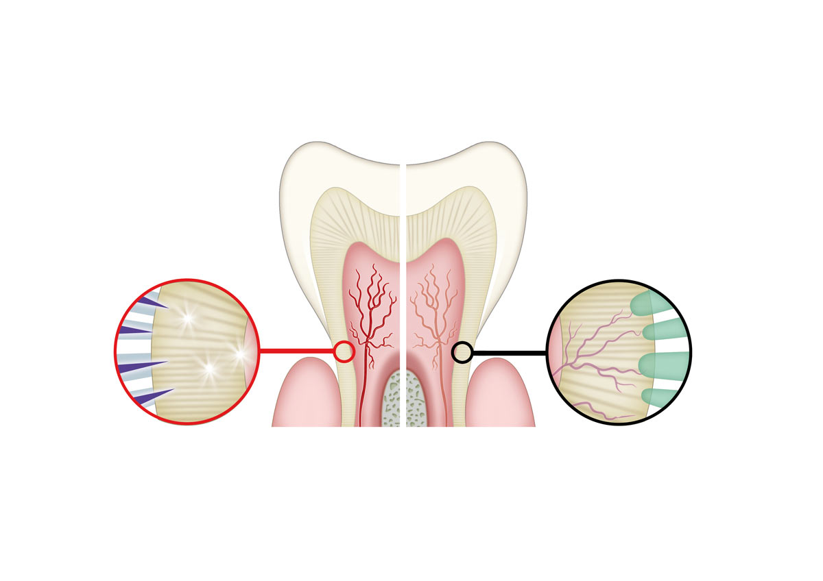 illustrazione sensibilità dentale