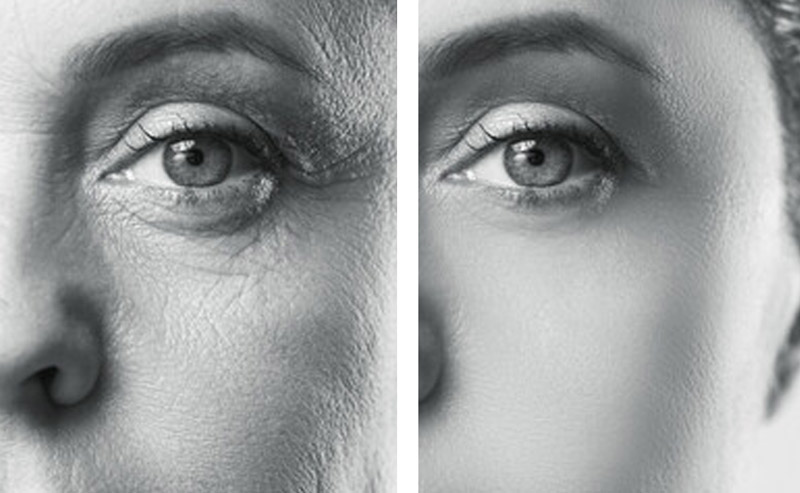 Immagine di prima e dopo il trattamento di medicina estetica