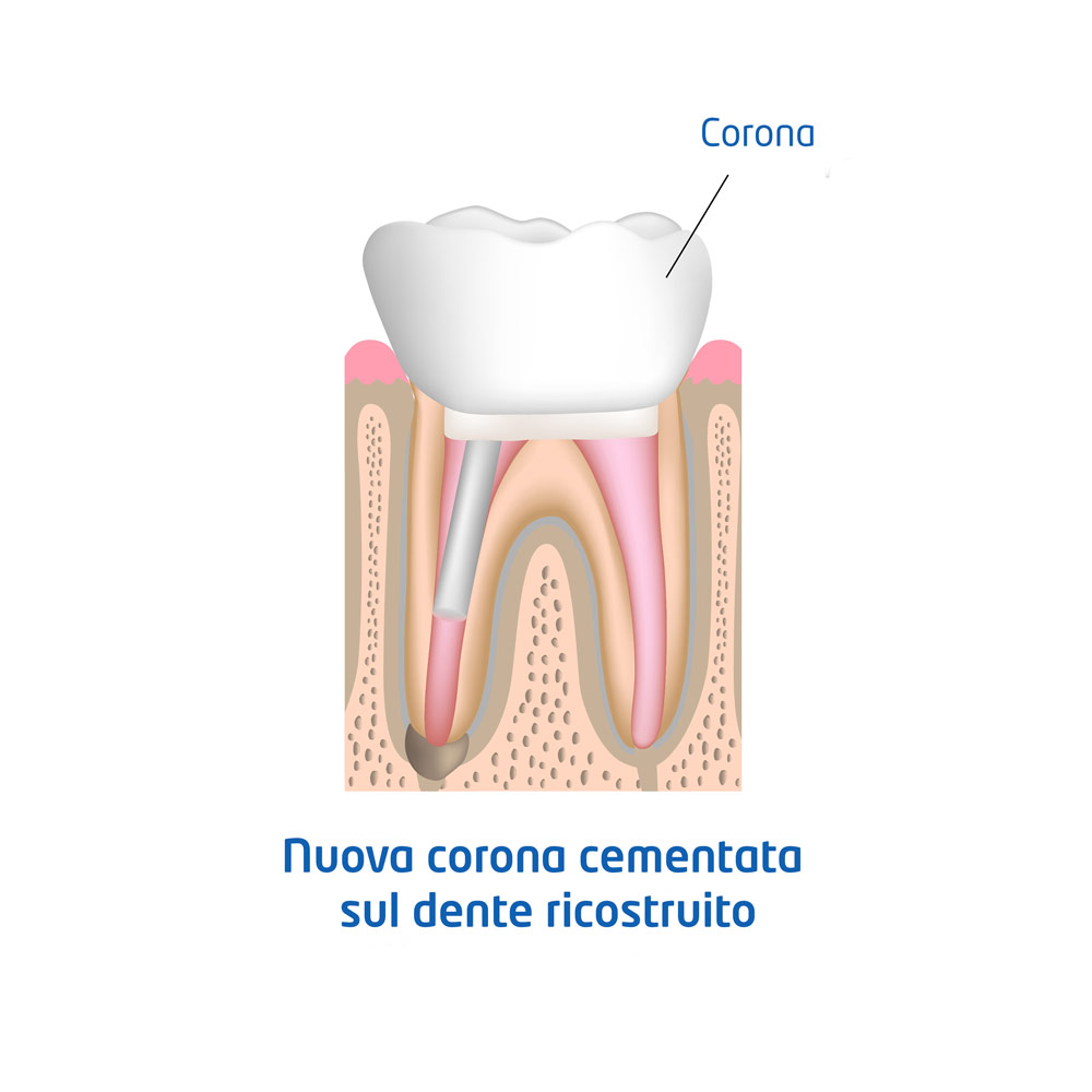 Illustrazione - nuova-corona-cementata-sul-dente-ricostruito
